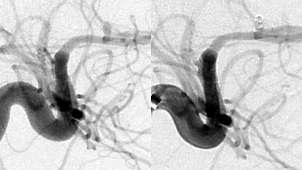 Versatile coil used to treat a ruptured right A1-A2 junction aneurysm