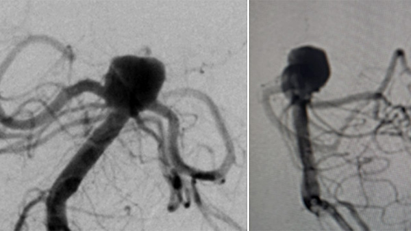 Web device for direct percutaneous puncture of the left vertebral artery