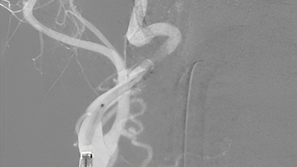 Wide-neck MCA aneurysm with severe carotid tortuosity