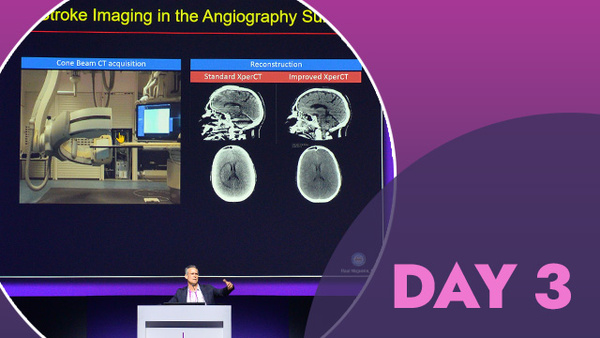 Day 3 Highlights from LINNC Paris 2026 – MeVO, improving outcomes after thrombectomy & simulation to tailor aneurysm treatment