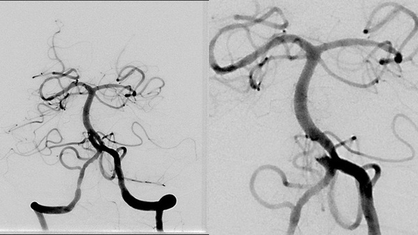 Mechanical thrombectomy of basilar artery fenestration