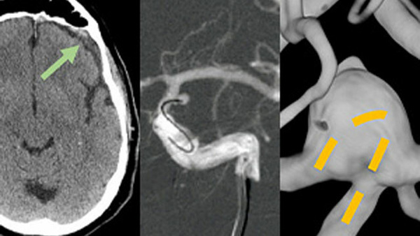 Innovative endovascular strategies for challenging accesses, tiny aneurysms treatment and MMA embolization