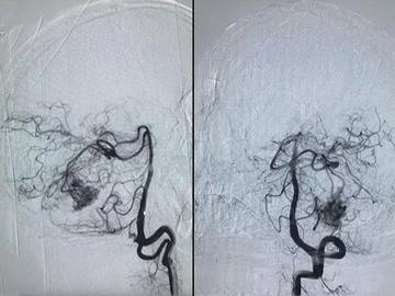 1 patient 2 pathologies - 55 y/o male with posterior fossa avm with a prenidal aneurysm