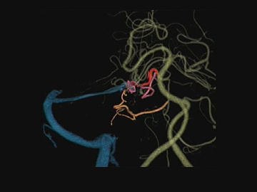A Case of Ruptured Brain Stem AVM Causing vessel Perforation during Transvenous Embolization
