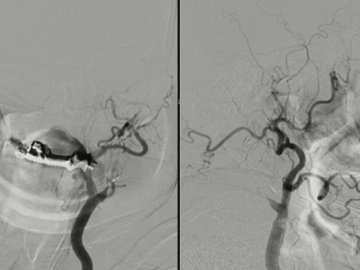 challenging stroke case
