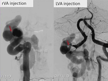 A rare and surprising cause of cervical myelopathy