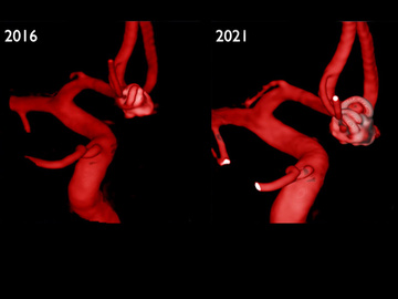 ACom Aneurysm Recurrence treated with Flow diverter using Radial approach