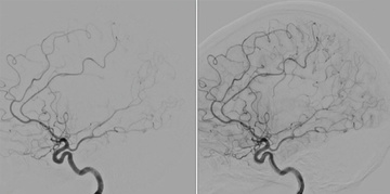 An unusual case of stroke