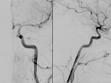 Aneurysm on the left ICA in carotid cave segment