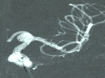 Aneurysm treated with coils and flow diverter