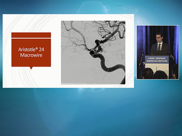 Aristotle®-Only ADAPT: A Novel Technique Utilizing Macrowires for Ischemic Stroke