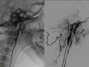 Ascending pharyngeal with its “dangerous” anastomoses