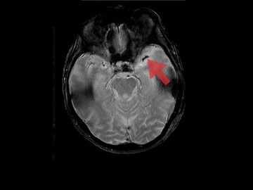 Aspiration in M1 occlusion in a patient with low NIHSS