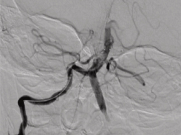 Asymptomatic bilateral VA occlusion after cardiac coil migration