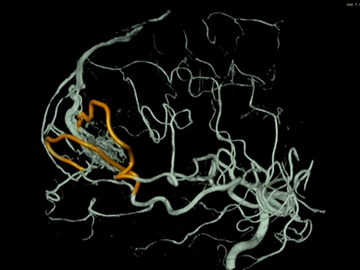 AVM treated with PHIL