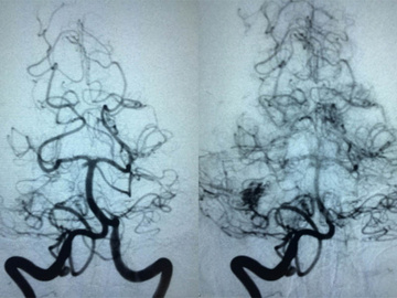 AVM with flow related aneurysm