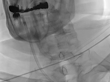 BADASS technique achieved large clot removal