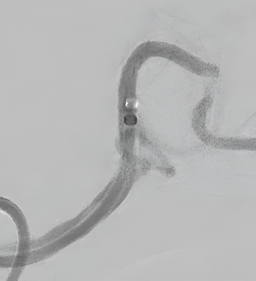 Basilar artery occlusion recanalized with thrombectomy, PTA and stenting via right transradial access