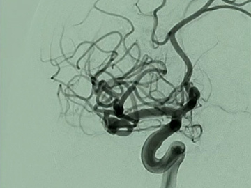 Bi-lobulated ACA aneurysm simulation treatment with WEB in silicon model 