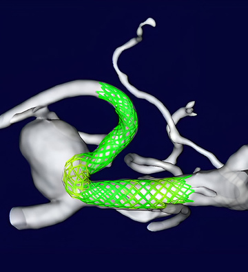 Bifurcation challenges in unruptured MCA aneurysm