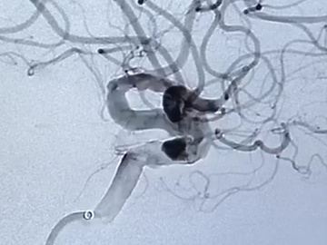 Bilateral multiple ACI aneurysms treated using the new Silk Vista Mama Flow Diverter