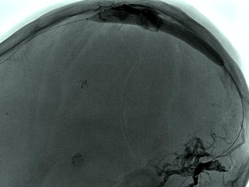 Bilateral sigmoid sinuses stenosis with secondary multiple DAVF 