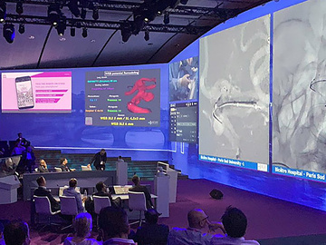 Capturing a world of interventional neuroradiology and neurology experience