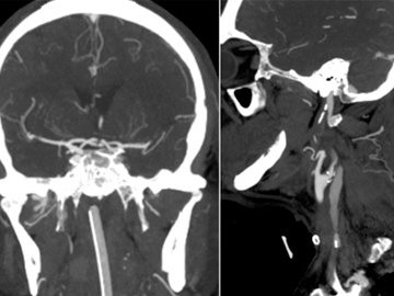Carotid blowout during attempted thrombectomy