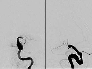 Carotid terminus occlusion treated with TIGER XL device