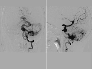 Cerebellar AVM with occipital artery and PICA feeding