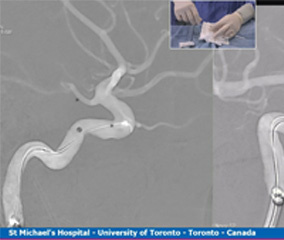 Coiling of an unruptured right P1-P2 aneurysm through the PComA