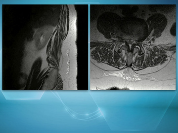 Combined embolization for spinal epidural venous fistula