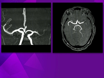 Delayed and distal thrombectomy remains beneficial