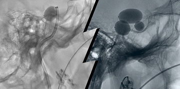 Two steps two philosophies to treat a direct CCF