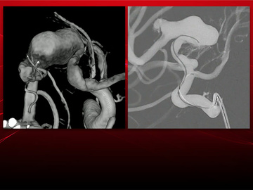 Dive into the unique case of a 14-year-old patient with a giant aneurysm