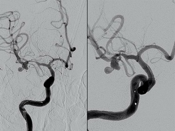 Double microcatheter technique for ruptured MCA aneurysm
