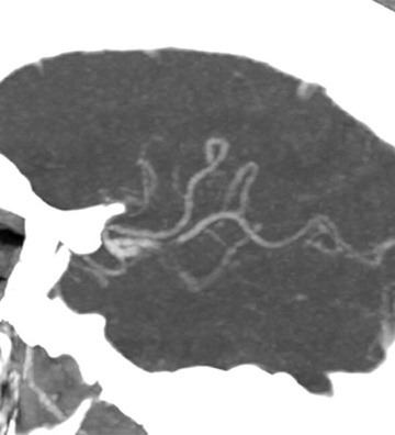 Elective thrombectomy with combined technique in M2 occlusion