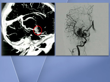Embolization for Basal Ganglia AVMs