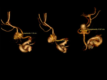 Embolization of anterior communicating artery aneurysm with two braided stents in "X"