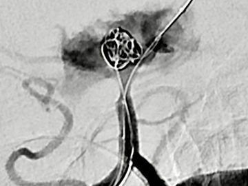 Endovascular bail-out after massive rupture for elective basilar tip aneurysm coiling 