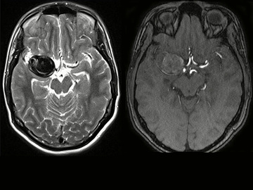 Endovascular occlusion of a complex MCA aneurysm