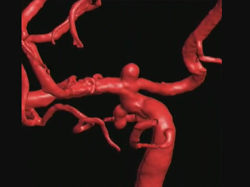Endovascular Treatment of Brain Aneurysms