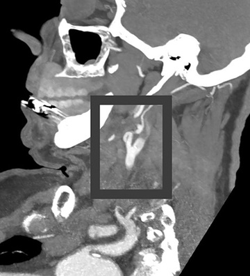 Extensive thrombus burden: Using the right material in the right situation leads to success