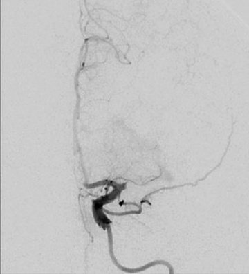 Extensive thrombus burden: Using the right material in the right situation leads to success