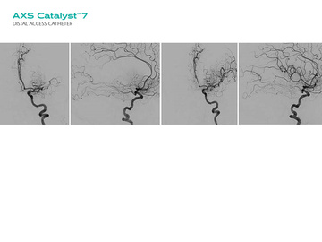 First European experience with the AXS Catalyst 7 Distal Access Catheter