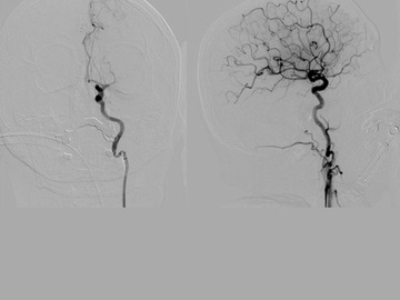 First stroke patient treated with Cyclical Aspiration