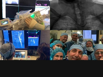 First transradial robotic carotid stenting in the US