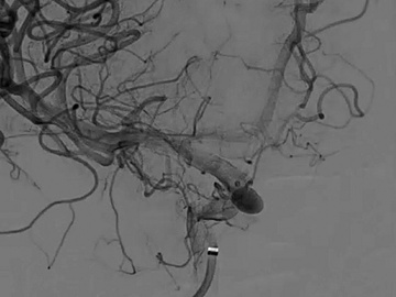 First US treatment of 3 patients with the FRED device