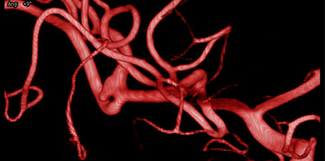 First use of LVIS Evo stent in England