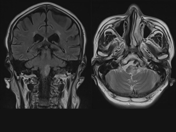 Foramen magnum dural AVF